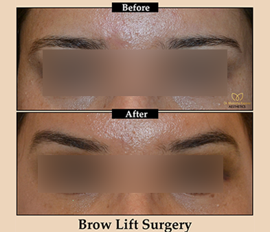 brow-patient6